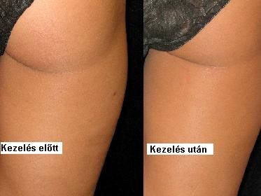 kezels_eltt.jpg